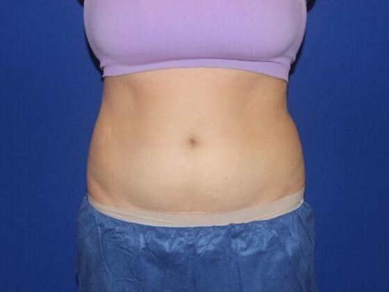 CoolSculpting Case 10 - Before