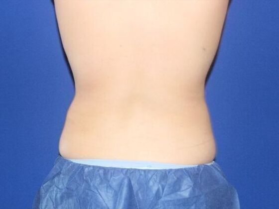CoolSculpting: Case 10 - After