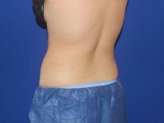 CoolSculpting: Case 10 - After