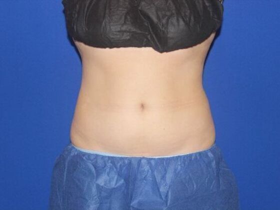CoolSculpting Case 10 - After