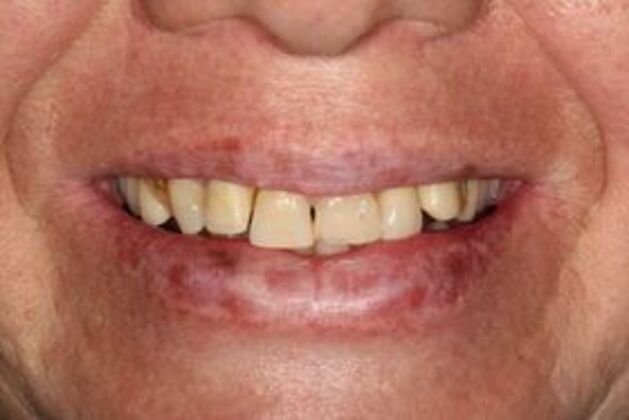 All-on-4 Dental Implants Brooklyn, NY Case 6 - Before