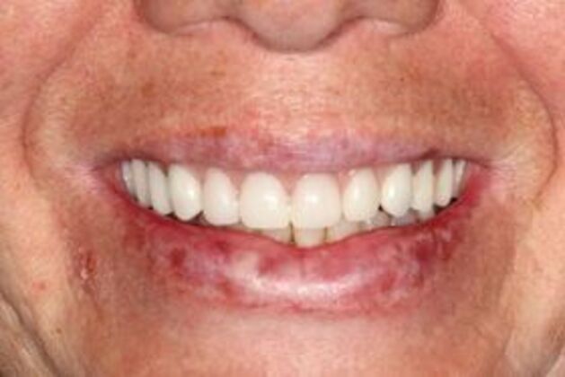 All-on-4 Dental Implants Brooklyn, NY Case 6 - After