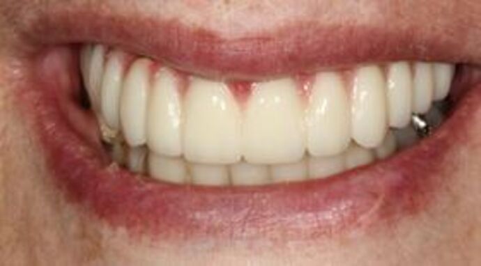 All-on-4 Dental Implants Brooklyn, NY Case 7 - After