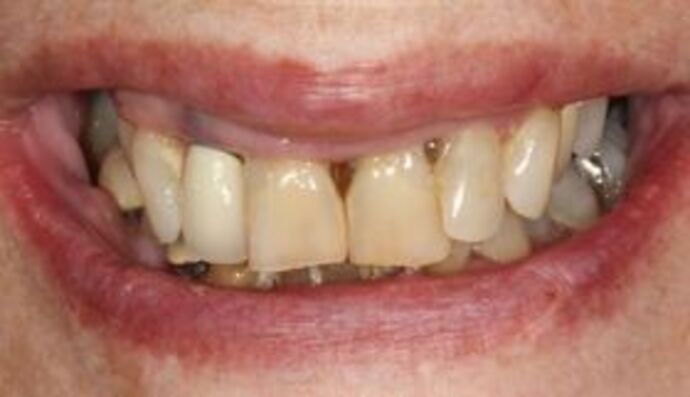 All-on-4 Dental Implants Brooklyn, NY Case 7 - Before