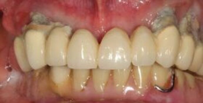 All-on-4 Dental Implants Brooklyn, NY Case 8 - Before
