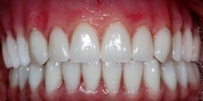All-on-4 Dental Implants Brooklyn, NY Case 8 - After