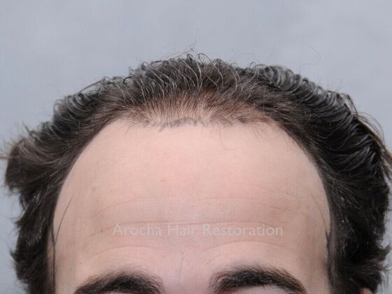 FUT Hair Restoration: Case 34 - Before