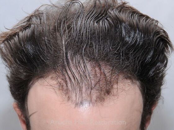 FUT Hair Restoration: Case 34 - Before