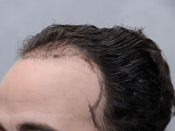 FUT Hair Restoration: Case 34 - Before