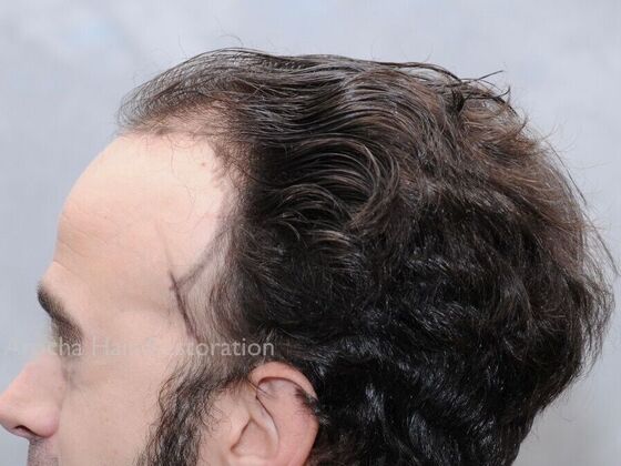 FUT Hair Restoration: Case 34 - Before