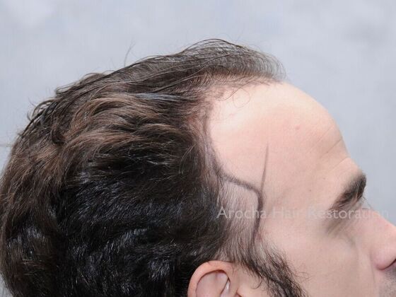 FUT Hair Restoration: Case 34 - Before