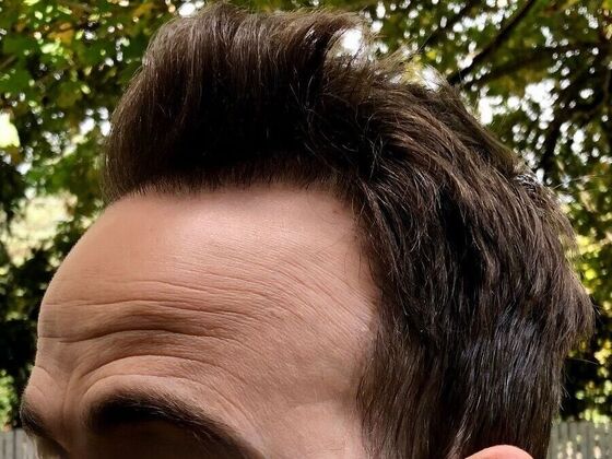 FUT Hair Restoration: Case 34 - After