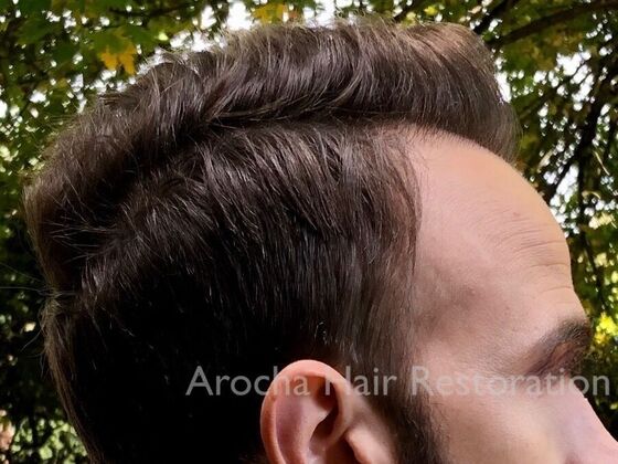 FUT Hair Restoration: Case 34 - After