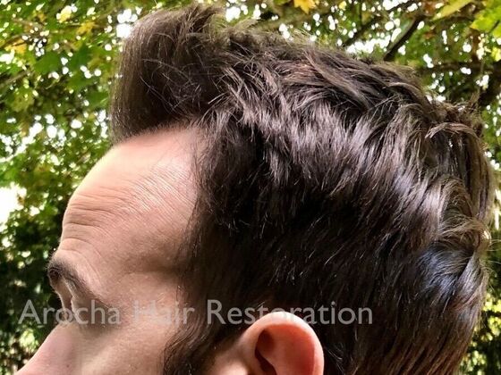 FUT Hair Restoration: Case 34 - After