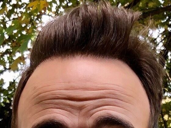 FUT Hair Restoration: Case 34 - Before