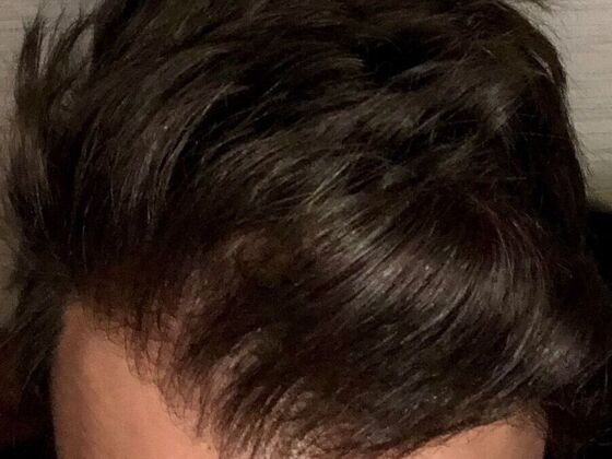 FUT Hair Restoration: Case 34 - After