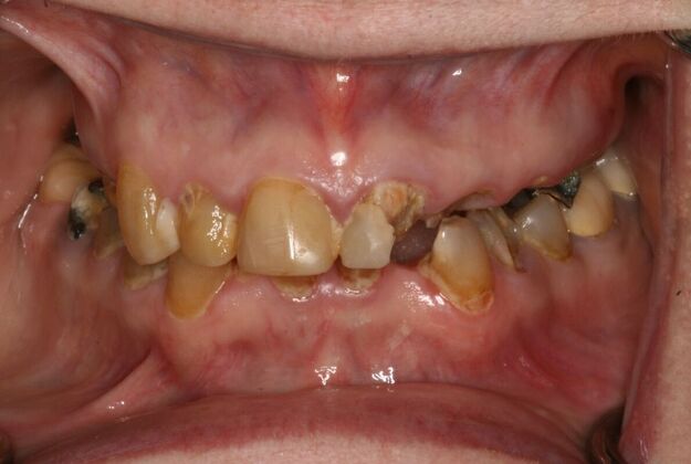 All-on-4/ Full Mouth Dental Implants / Teeth in a Day: Case 13- Upper and Lower All on 4 Bridges - Before