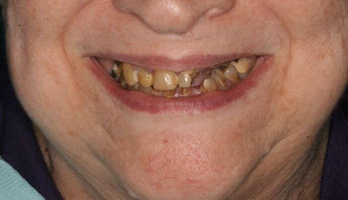 All-on-4/ Full Mouth Dental Implants / Teeth in a Day: Case 13- Upper and Lower All on 4 Bridges - Before