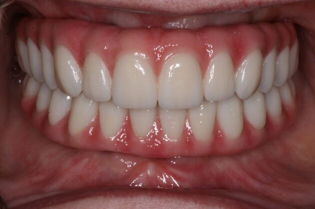 All-on-4/ Full Mouth Dental Implants / Teeth in a Day: Case 13- Upper and Lower All on 4 Bridges - After