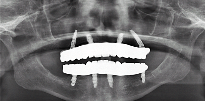 All-on-4/ Full Mouth Dental Implants / Teeth in a Day: Case 13- Upper and Lower All on 4 Bridges - After