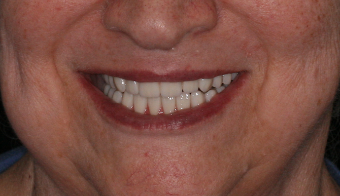 All-on-4/ Full Mouth Dental Implants / Teeth in a Day: Case 13- Upper and Lower All on 4 Bridges - After