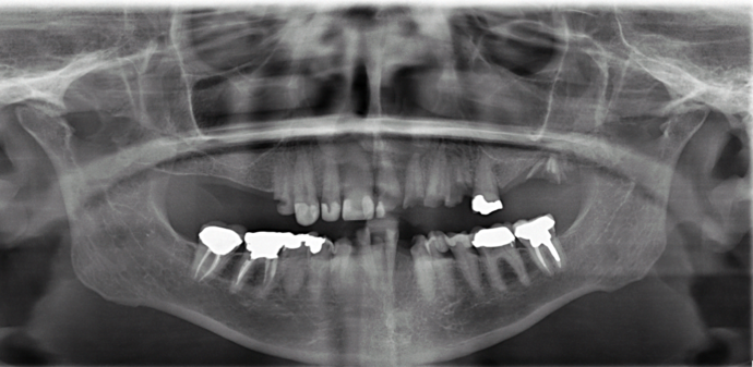 All-on-4/ Full Mouth Dental Implants / Teeth in a Day: Case 13- Upper and Lower All on 4 Bridges - Before