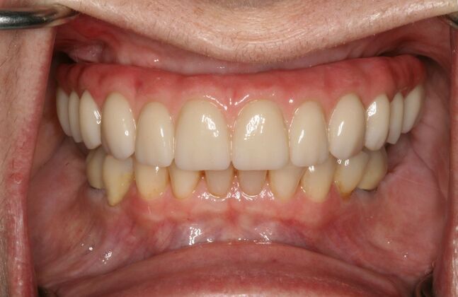 All-on-4/ Full Mouth Dental Implants / Teeth in a Day Case 14-Upper All-on-4 Bridge and Lower single implants - After