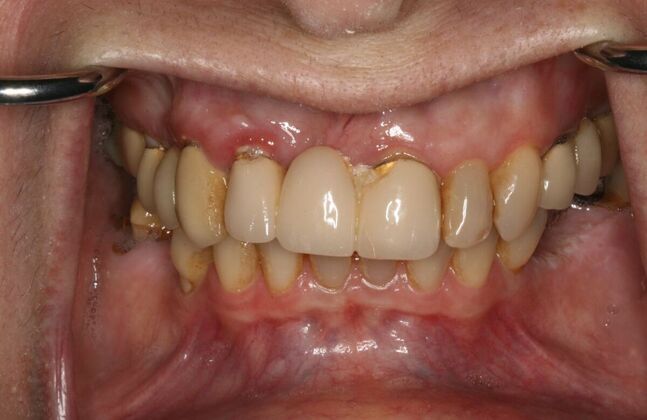 All-on-4/ Full Mouth Dental Implants / Teeth in a Day Case 14-Upper All-on-4 Bridge and Lower single implants - Before