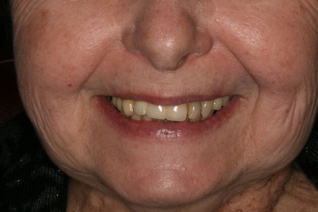 All-on-4/ Full Mouth Dental Implants / Teeth in a Day: Case 14-Upper All-on-4 Bridge and Lower single implants - Before