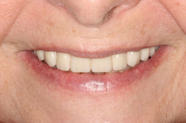 All-on-4/ Full Mouth Dental Implants / Teeth in a Day: Case 14-Upper All-on-4 Bridge and Lower single implants - After