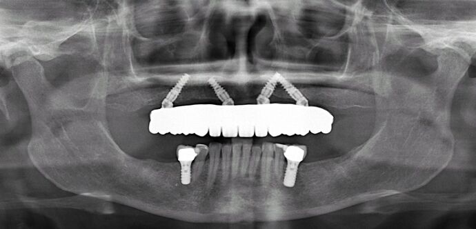 All-on-4/ Full Mouth Dental Implants / Teeth in a Day: Case 14-Upper All-on-4 Bridge and Lower single implants - After