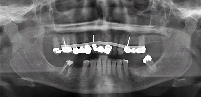 All-on-4/ Full Mouth Dental Implants / Teeth in a Day: Case 14-Upper All-on-4 Bridge and Lower single implants - Before