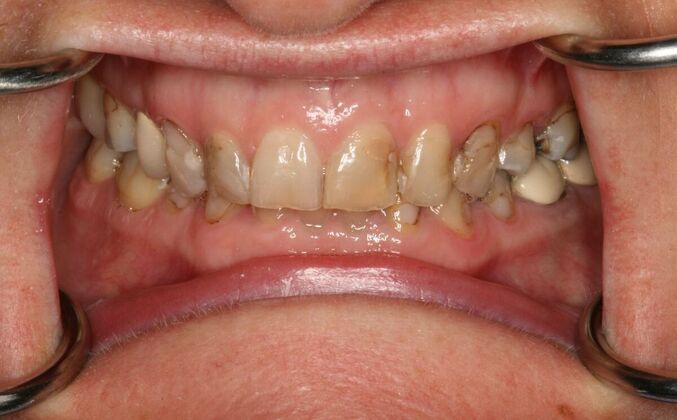 All-on-4/ Full Mouth Dental Implants / Teeth in a Day: Case 15- Full mouth implants-upper and lower - Before