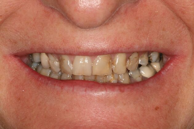 All-on-4/ Full Mouth Dental Implants / Teeth in a Day: Case 15- Full mouth implants-upper and lower - Before