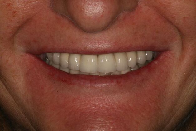 All-on-4/ Full Mouth Dental Implants / Teeth in a Day: Case 15- Full mouth implants-upper and lower - After
