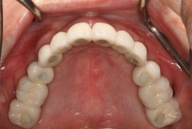 All-on-4/ Full Mouth Dental Implants / Teeth in a Day: Case 15- Full mouth implants-upper and lower - After