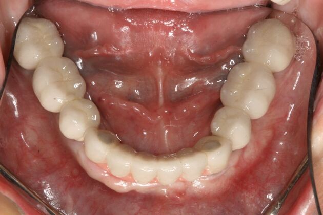 All-on-4/ Full Mouth Dental Implants / Teeth in a Day: Case 15- Full mouth implants-upper and lower - After