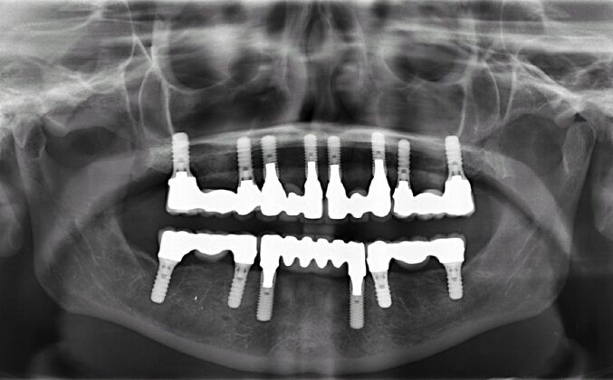 All-on-4/ Full Mouth Dental Implants / Teeth in a Day: Case 15- Full mouth implants-upper and lower - After