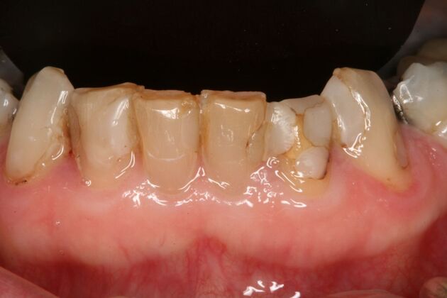 All-on-4/ Full Mouth Dental Implants / Teeth in a Day: Case 15- Full mouth implants-upper and lower - Before