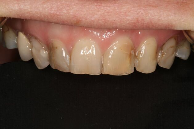 All-on-4/ Full Mouth Dental Implants / Teeth in a Day: Case 15- Full mouth implants-upper and lower - Before