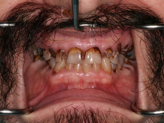 All-on-4/ Full Mouth Dental Implants / Teeth in a Day: Case 16-Upper and Lower All-on-4 Bridges - Before