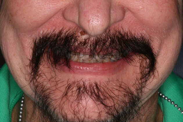 All-on-4/ Full Mouth Dental Implants / Teeth in a Day: Case 16-Upper and Lower All-on-4 Bridges - Before