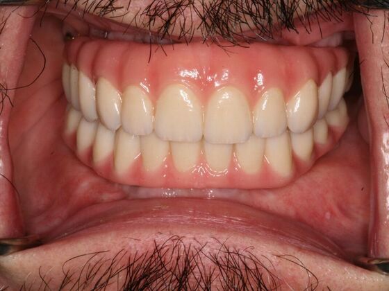 All-on-4/ Full Mouth Dental Implants / Teeth in a Day: Case 16-Upper and Lower All-on-4 Bridges - After