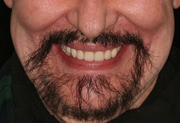 All-on-4/ Full Mouth Dental Implants / Teeth in a Day: Case 16-Upper and Lower All-on-4 Bridges - After