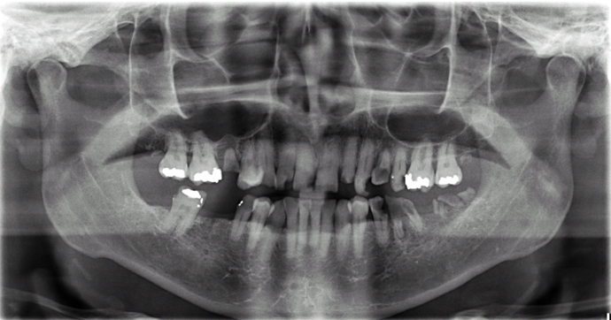 All-on-4/ Full Mouth Dental Implants / Teeth in a Day: Case 16-Upper and Lower All-on-4 Bridges - Before