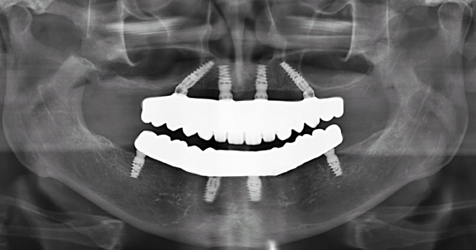 All-on-4/ Full Mouth Dental Implants / Teeth in a Day: Case 16-Upper and Lower All-on-4 Bridges - After