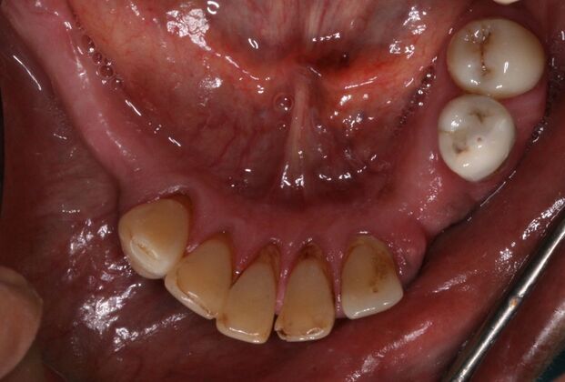 All-on-4/ Full Mouth Dental Implants / Teeth in a Day: Case 17- Upper and Lower All-on-4 Bridges - Before