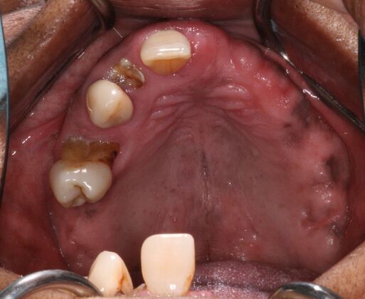 All-on-4/ Full Mouth Dental Implants / Teeth in a Day: Case 17- Upper and Lower All-on-4 Bridges - Before