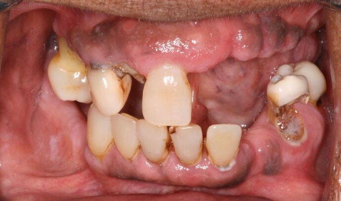 All-on-4/ Full Mouth Dental Implants / Teeth in a Day: Case 17- Upper and Lower All-on-4 Bridges - Before