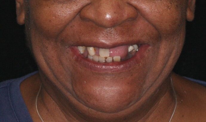 All-on-4/ Full Mouth Dental Implants / Teeth in a Day: Case 17- Upper and Lower All-on-4 Bridges - Before